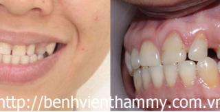 Chỉnh hình răng thẩm mỹ điều trị răng thưa + Răng nanh mọc sai chỗ