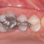 Trám răng bằng vật liệu trám Amalgam bền chắc nhưng kém thẫm mỹ
