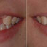 Chịu lực tức thì trên Implant là gì?