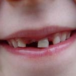 Một số lưu ý khi trẻ thay răng
