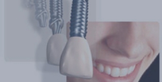 Có nên cấy ghép - implant răng?