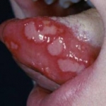 Loét miệng ở trẻ em 