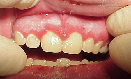 Herpes gingivitis