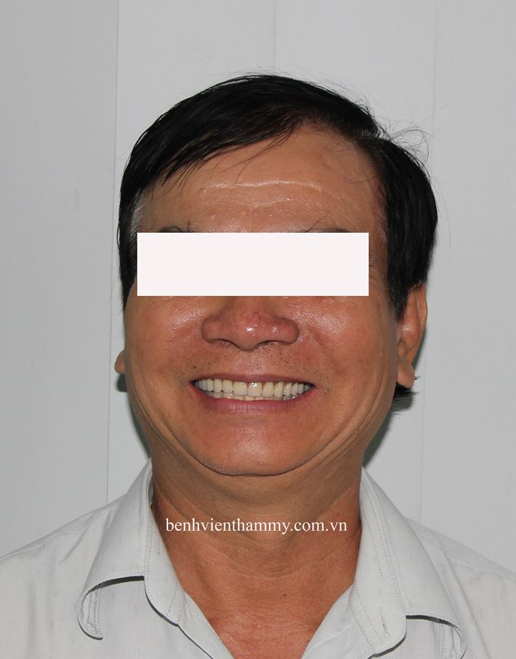 implant toan ham5