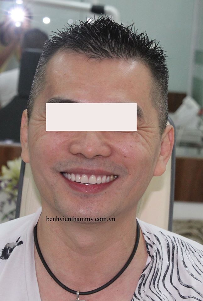 implant toan ham7