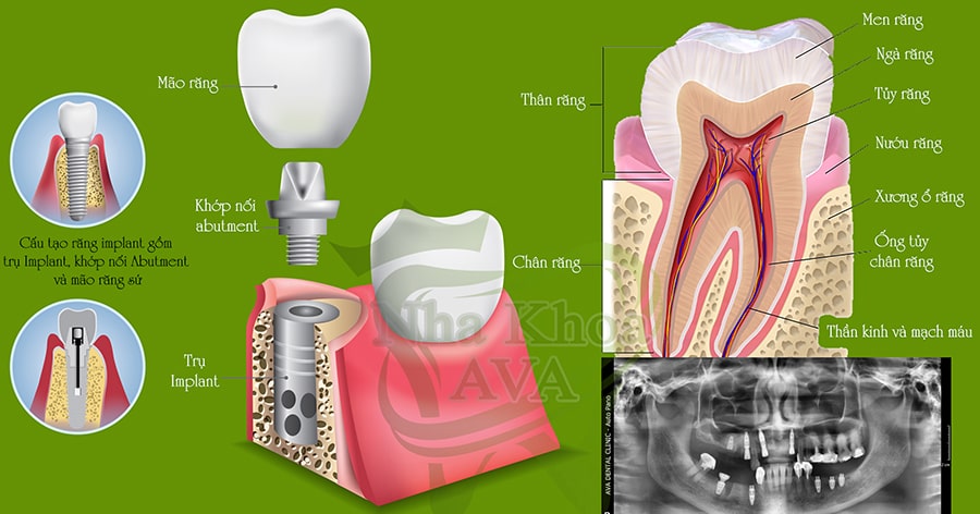 cay ghep rang implant