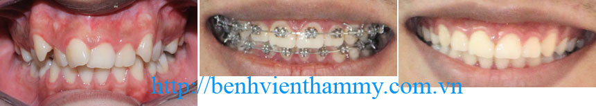 nieng-rang-tham-my01