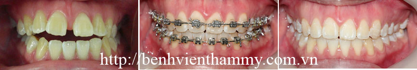 nieng-rang-tham-my04