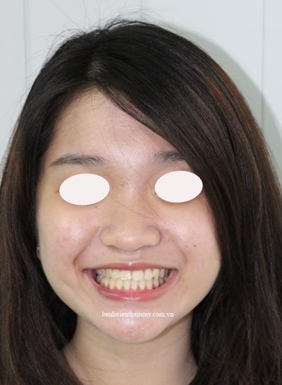nieng-rang-khong-nho-rang-4