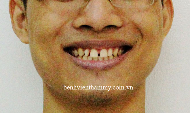 rang thua b1 copy