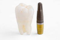 dental-implant