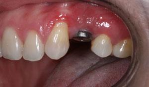 cam-implant