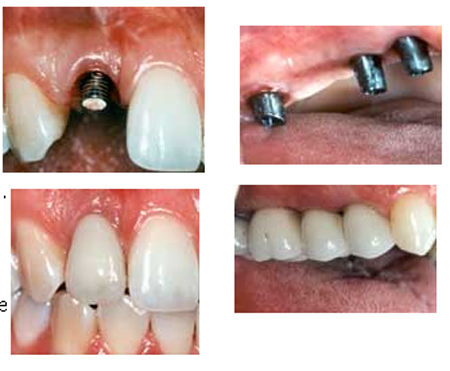 Dental_Implant-1
