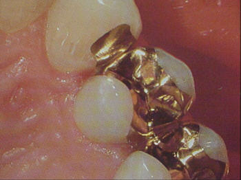 goldinlay