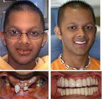 implant_before_after2